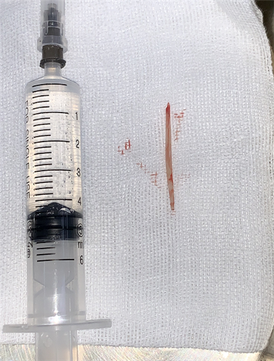 5旬男子误吞鱼刺一周后咽痛高热，结果......